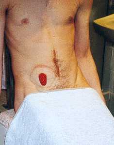 The stoma.