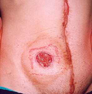 The stoma site.