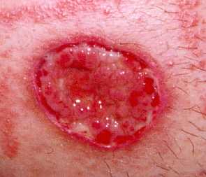 Close up of the stoma site.