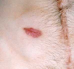 The Stoma site healed