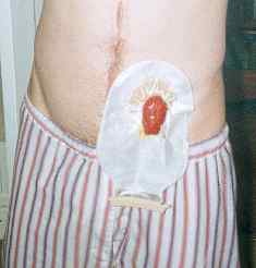 Stoma and bag.