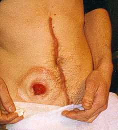 Stoma post pouch formation.