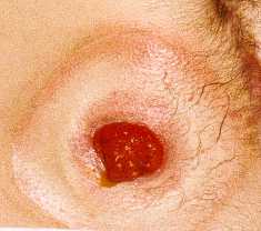 Close up of loop ileostomy.